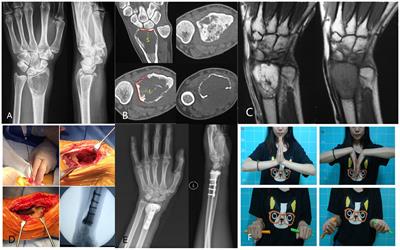 Microwave-assisted intralesional curettage combined with other adjuvant methods for treatment of Campanacci III giant cell tumor of bone in distal radius: a multicenter clinical study